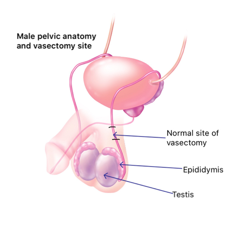 What factors affect the success rate for vasectomy reversal procedure?